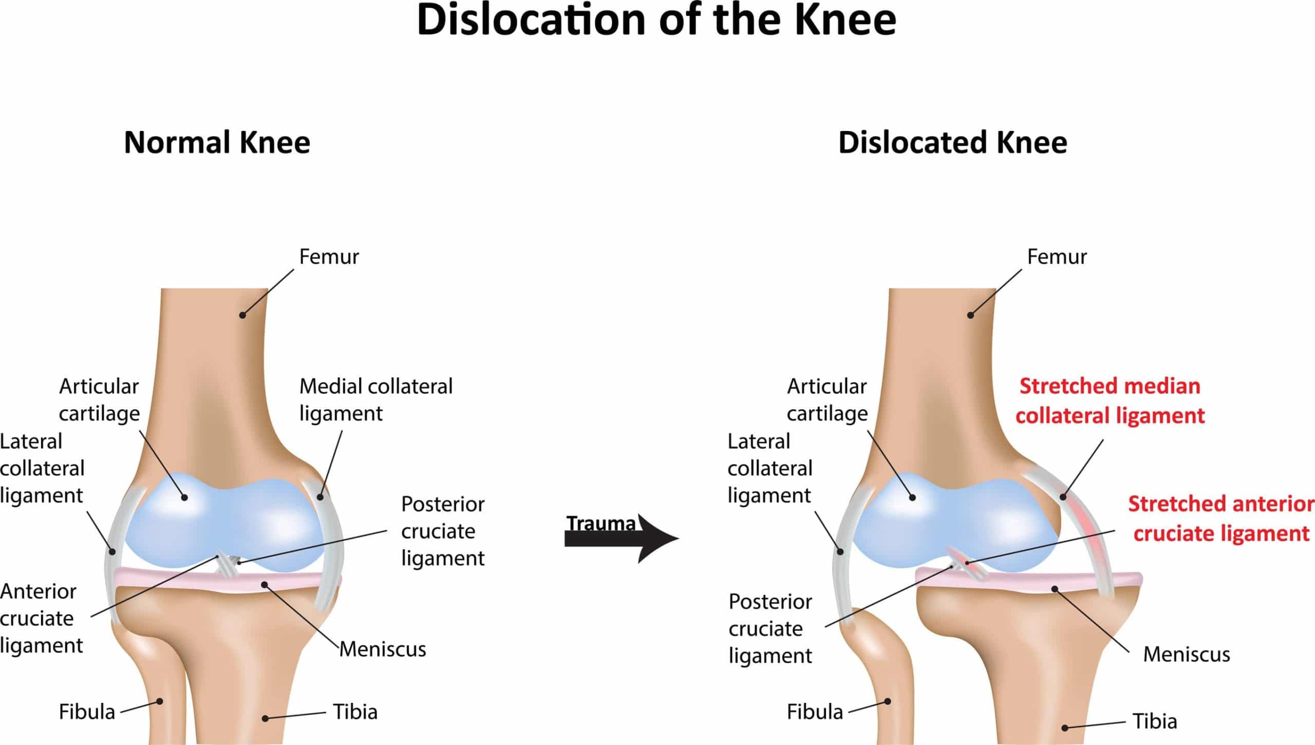 Dislocated Knee Therapy